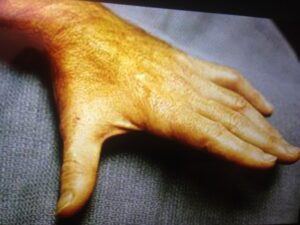 Ωλένια Νευρίτιδα