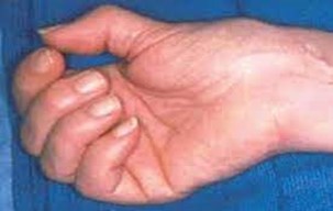 αρθρίτιδα βασικής άρθρωσης αντίχειρα - παραμόρφωση